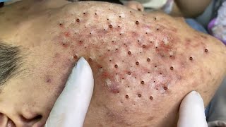 Big Cystic Acne Blackheads Extraction Blackheads amp Milia Whiteheads Removal Pimple Popping  9181 [upl. by Ise]