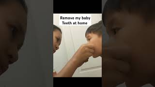 I removed my baby teeth at home using dental floss [upl. by Revell]