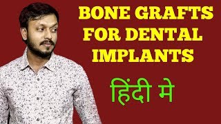 Bone grafts for dental implants  Bone grafts kya hota hai  DrVaibhav [upl. by Demp]