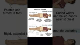 Decorticate posturing and Decerebrate posturing  important for bpt👀☠️📝 [upl. by Demah]