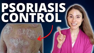 TOP 5 TIPS TO CONTROL PSORIASIS FLARES 😊 DERMATOLOGIST DrDrayzday [upl. by Nairot]