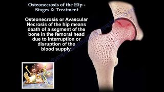 Osteonecrosis Of The Hip Stages amp Treatment  Everything You Need To Know  Dr Nabil [upl. by Llerrot]