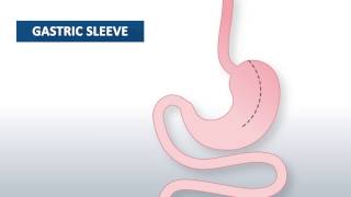 What is gastric sleeve surgery  Beaumont Health [upl. by Brawley]