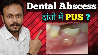 दाँतों में पस फोड़ी से कैसे पाएं छुटकारा  Dental Abscess Treatment in Hindi Types of dental abscess [upl. by Eeldivad]