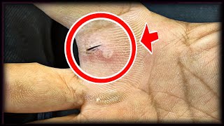 ASMR BARBER Removal of ingrown hair in my Hend ingrown hair removal [upl. by Trev422]