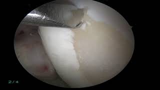 Microfracture Chondroplasty [upl. by Stilu]