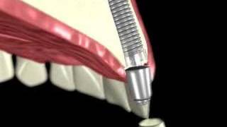 3D Medical Animation of a Dental Implant [upl. by Ailaham858]