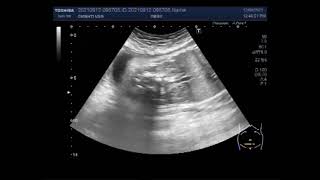 Dilated ventricles Cleft lip Spina Bifida and Sacrococcygeal teratoma [upl. by Adaj553]