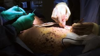 Woman Covered in Tumors Undergoes Surgery [upl. by Hassi]