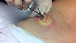 Lancing infected cyst  abscess [upl. by Adolphe]