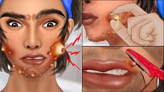 ASMR Popping pustule in jawline and face shaving Squeeze acne animation [upl. by Logan]