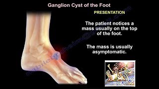 Foot and Ankle ganglion cyst  Everything You Need To Know  Dr Nabil Ebraheim [upl. by Gasser]