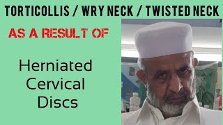 TORTICOLLISWry neck  Cervical Discs Herniation  Examination  Cervical DystoniaTWSTRS Scale [upl. by Melisenda982]