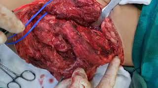 Hemipelvectomy 1استئصال نصف حوض مرحلة 1 [upl. by Hildegaard229]