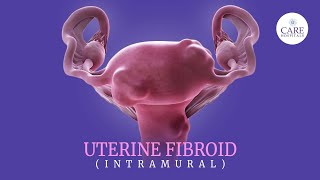 Uterine fibroids 5 signs you should never ignore  Treatment Options for Uterine Fibroids [upl. by Consalve]