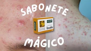 Sabonete de Enxofre suas perguntas mais frequentes respondidas Acne  Foliculite  Cravos [upl. by Goulette]