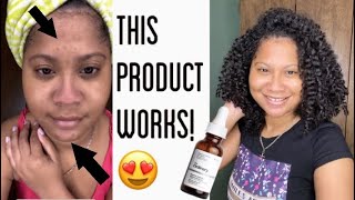 The Ordinary Ascorbic Acid 8  Alpha Arbutin 2 Review  Before And After [upl. by Aicatsue131]