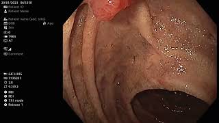 Stomach and Duodenum check up Gastroscopy 2023 01 20 [upl. by Ogires]