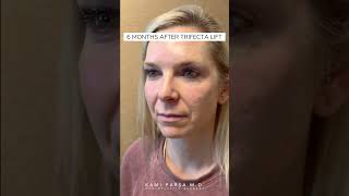 Before amp After Trifecta Lift for Puffy Eye Bags Volume loss amp Hollow Tear Troughs  Dr Kami Parsa [upl. by Sirdi407]