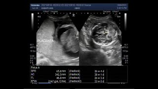 Hydrops fetalis with Soft tissue edema Cardiomegaly Pericardial effusion and ascites [upl. by Finnigan]