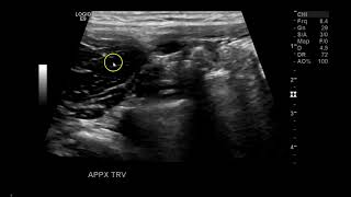 Appendix between RT External and Internal Iliac artery [upl. by Atteselrahc972]