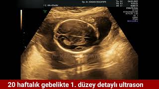 Detaylı ultrasonda bebeğin tepeden tırnağa organ taraması ve renkli Doppler nasıl yapılır 1 düzey [upl. by Aihsoem158]