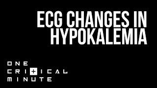 ECG Changes in Hypokalemia  One Critical Minute 1CM [upl. by Yecam]