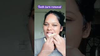 Unga pallu majal ha Eruka appo indha method use pannuga teeth teethwhitening beutyhack yadvi [upl. by Oiratno]