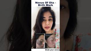 Dermatologist Dr Anvika Reveals The Solution Of Nevus Of Ota [upl. by Lakym176]