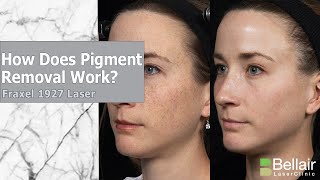 How does Fraxel work for pigmentation [upl. by Noonberg511]