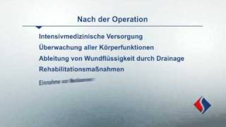 Rekonstruktion und Ersatz der Aortenklappe Teil 8  Nach der Operation [upl. by Derman39]