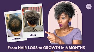 From HAIR LOSS to HAIR GROWTH in 6 MONTHS 🙀 [upl. by Ainalem]