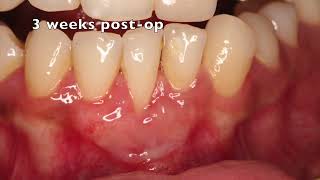 Free Gingival Graft in a thin biotype [upl. by Aiderfla]