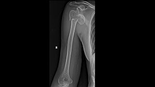 Hertels criteria for proximal humerus fractures everything you need to know with XRay examples [upl. by Glasgo169]