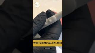 Safe and Effective Wart Removal Treatment with Dr Ahmad [upl. by Reece555]