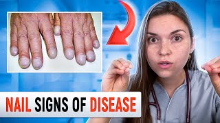 Doctor Explains what your NAILS say about your HEALTH Top 10 Nail Problems [upl. by Archambault]