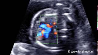 Fetal heart Academy  Heterotaxy 1 four chamber view color Doppler example 2 [upl. by Nai65]