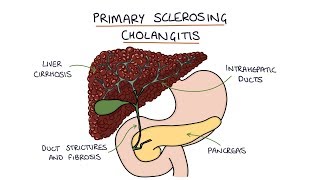 Primary Sclerosing Cholangitis Visual Explanation for Students [upl. by Doroteya]