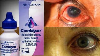 Combigan Eye Drop For Ocular Hypertension glaucoma  Brimonidine  Timolo [upl. by Tavia]