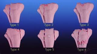 Tibial plateau fracture complexed [upl. by Sucrad]