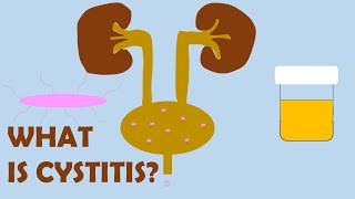 What is Cystitis [upl. by Kwang]