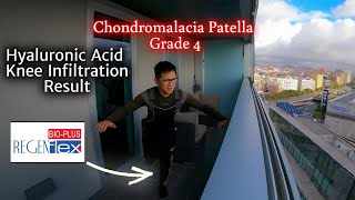 Hyaluronic Acid Knee Injection Result  Chondromalacia Patella Grade 4 [upl. by Hajan]