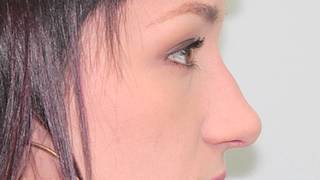 Rhinoplasty Surgical Plan Amanda part 1 of 10  Dr Thomas Buonassisi at 8 West Clinic in Vancouver [upl. by Maisey]