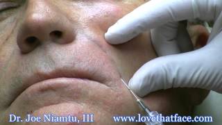 Nasolabial Fold Filler with Cannula by Dr Joe Niamtu [upl. by Usanis845]