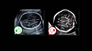 Biometría Básica Fetal [upl. by Koosis]