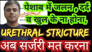 urethral stricture treatment with homeopathic medicines [upl. by Locklin]