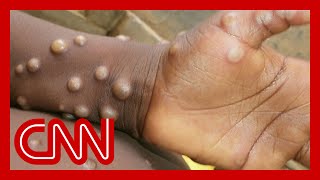 Monkeypox  how does it spread and what are the symptoms [upl. by Annawaj]