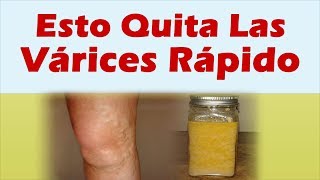 COMO QUITAR LAS VARICES RAPIDAMENTE Varices En Las Piernas Tratamiento Natural [upl. by Oigroig991]