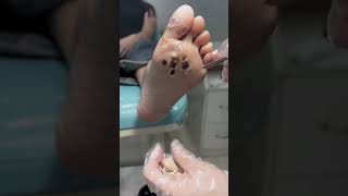 Treatment Callus and Dead skin Ep13  Sheng Clinic [upl. by Attenwahs]