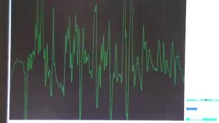 Myopathy EMG changes explained [upl. by Mario]